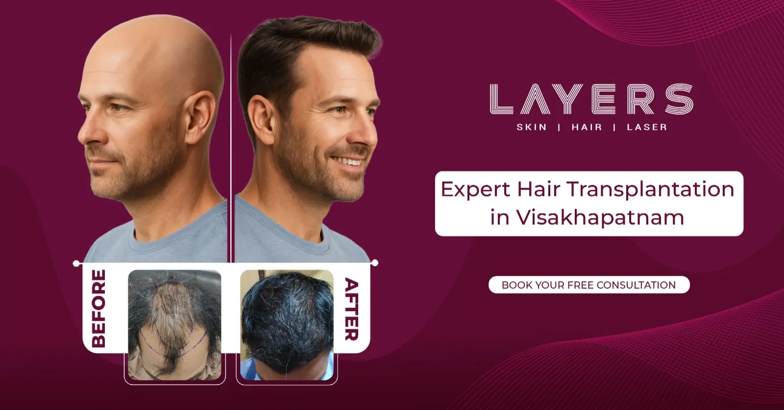 Hair Transplantation in Visakhapatnam