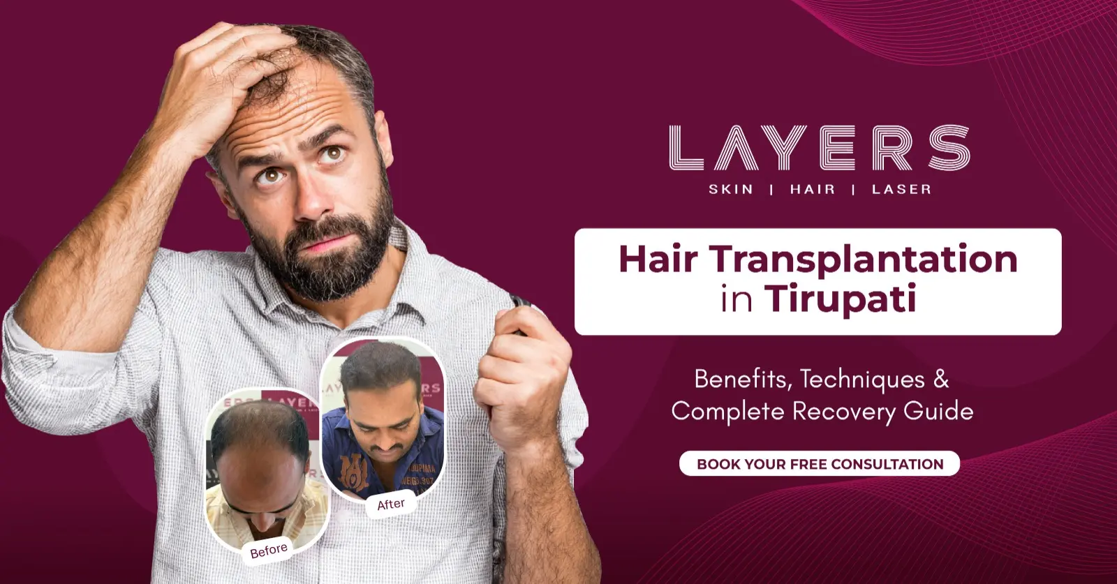 Hair Transplantation in Tirupati