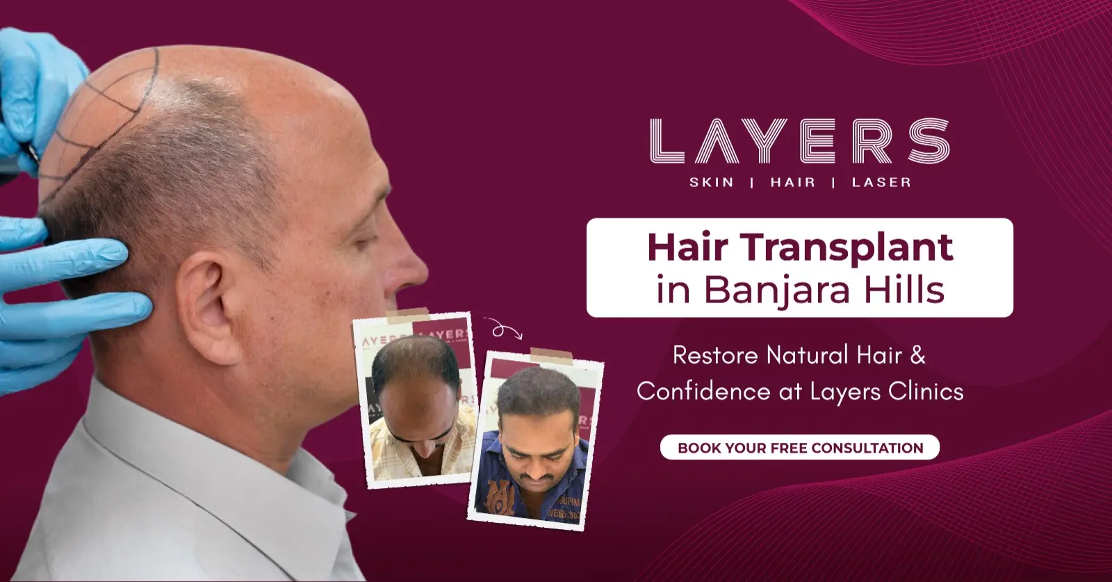 Hair Transplant in Banjara Hills