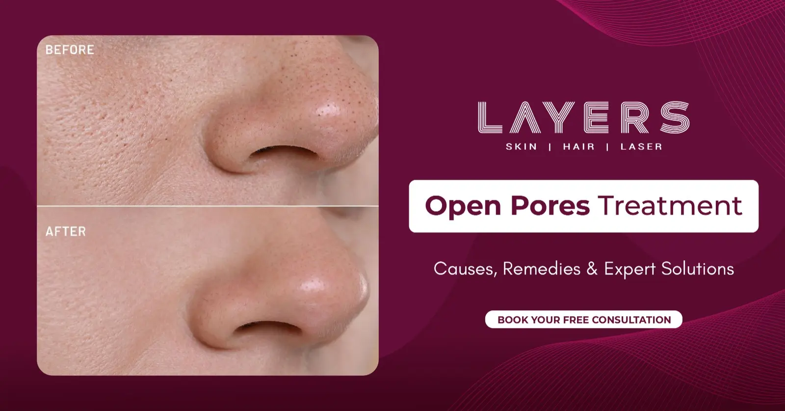 Open Pores Treatment