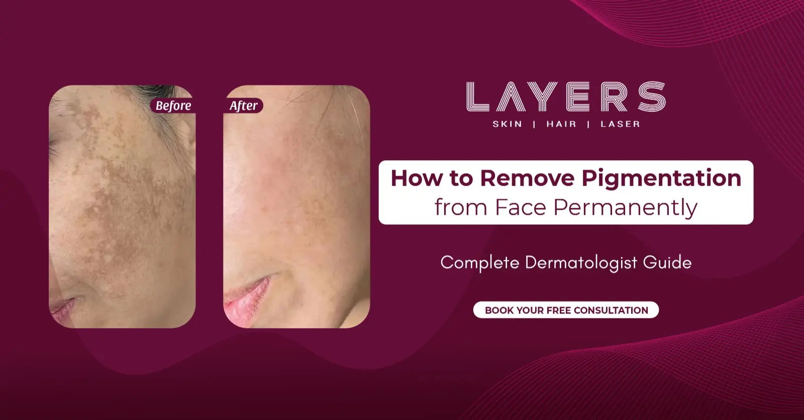 How to Remove Pigmentation from Face Permanently