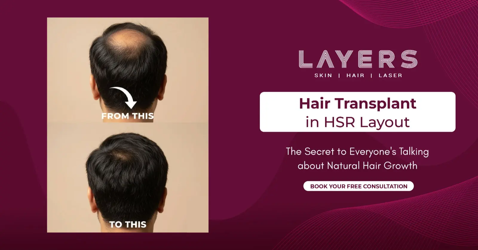 Hair Transplant in HSR Layout