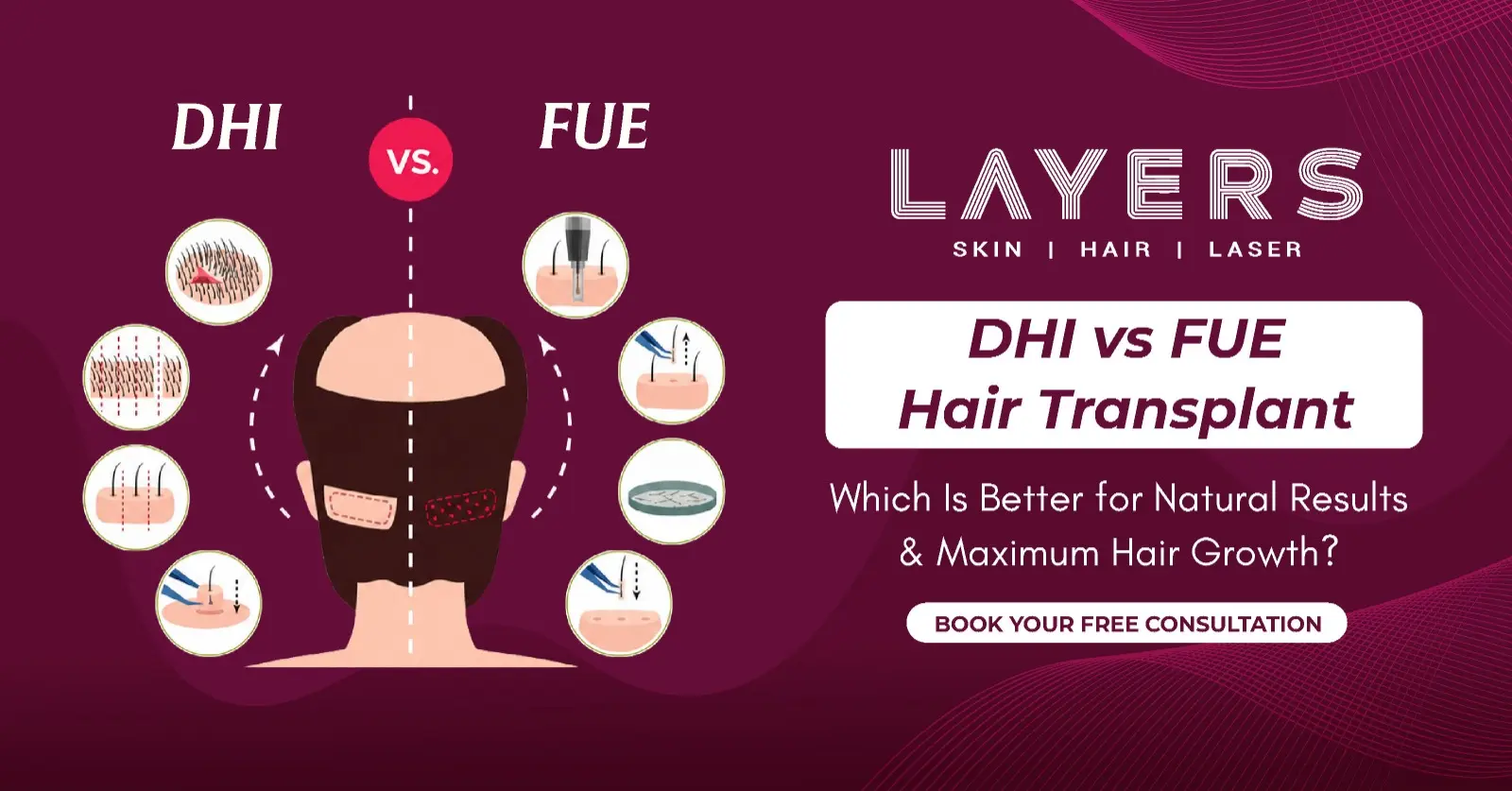DHI vs FUE Hair Transplant