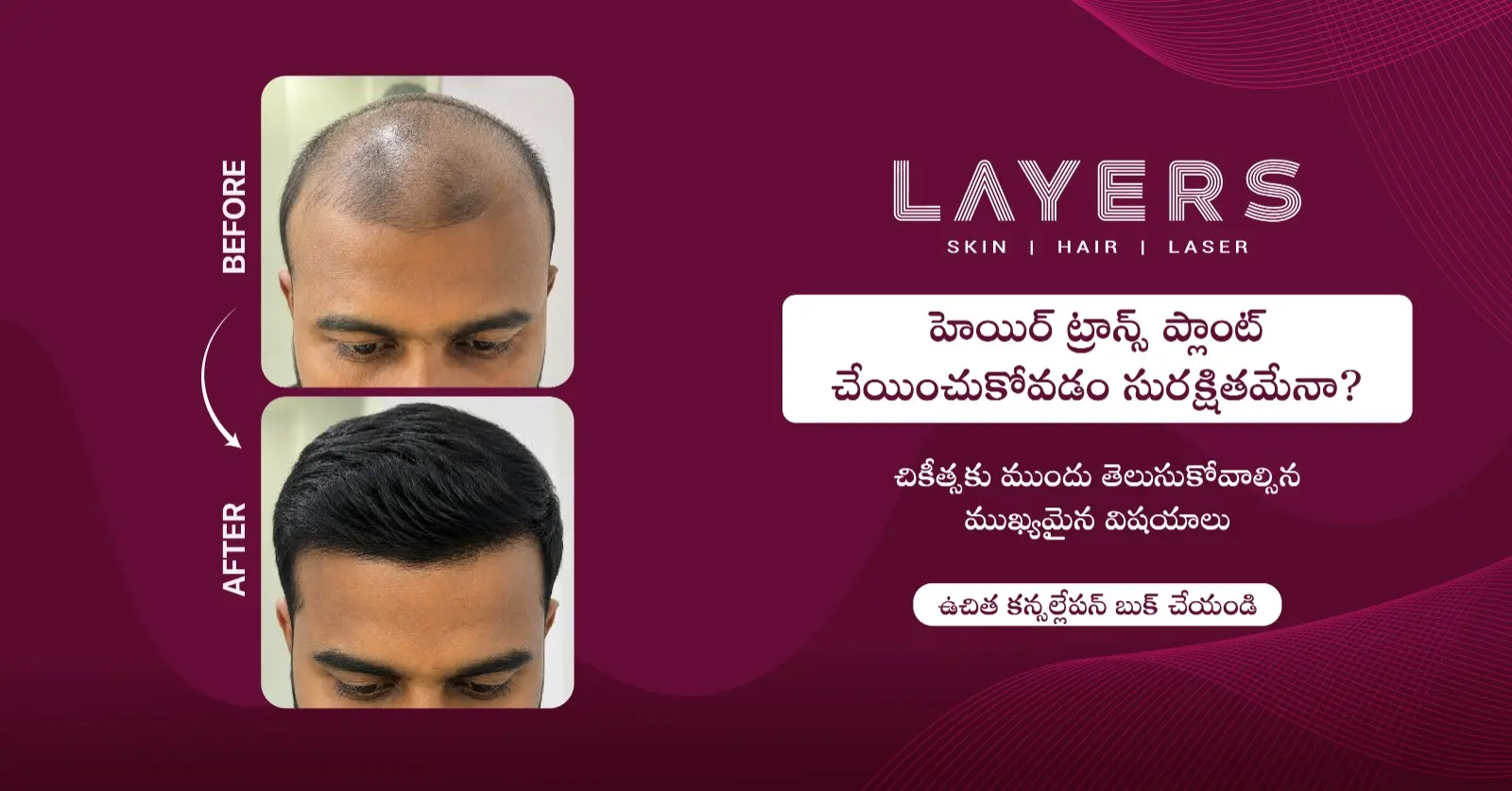 హెయిర్ ట్రాన్స్‌ప్లాంట్ చేయించుకోవడం సురక్షితమేనా 1